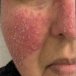 Atopic Dermatitis Before and after