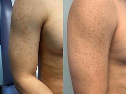 Eczema before and after