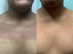 Eczema before and after