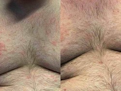 Eczema before and after