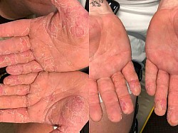 Eczema/ Atopic Dermatitis Before and After