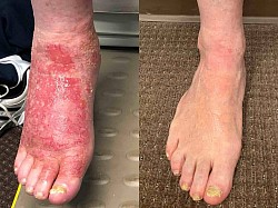 Eczema/ Atopic Dermatitis Before and After