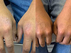 Eczema/ Atopic Dermatitis Before and After