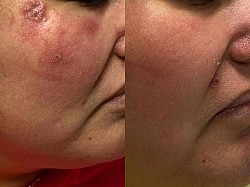 Eczema/ Atopic Dermatitis Before and After