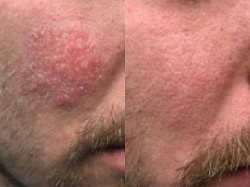 Eczema before and after