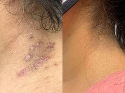 Eczema before and after
