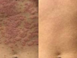 Psoriasis before and after
