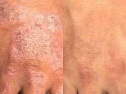 Psoriasis before and after