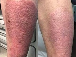 Psoriasis before and after