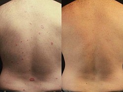 Psoriasis before and after