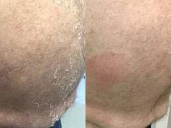 Psoriasis before and after