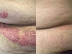 Psoriasis before and after