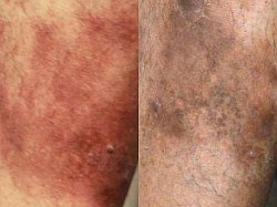Psoriasis before and after