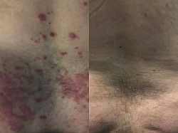 Psoriasis before and after