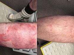 Psoriasis before and after