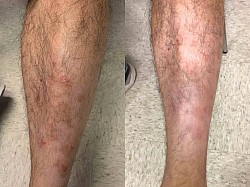 Psoriasis before and after