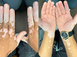 Vitiligo Before and After