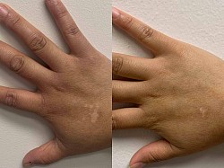 Vitiligo Before and After