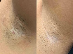 Vitiligo Before and After