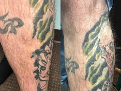 Psoriasis before and after