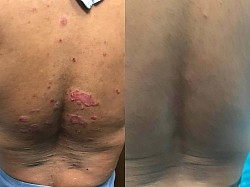 Psoriasis before and after