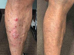 Psoriasis before and after