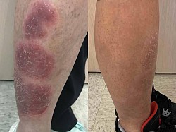 Psoriasis before and after
