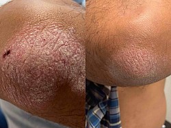 Psoriasis before and after