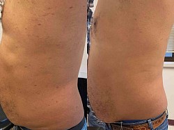 Psoriasis before and after
