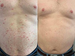 Psoriasis before and after