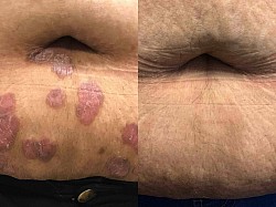 Psoriasis before and after