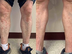 Psoriasis before and after