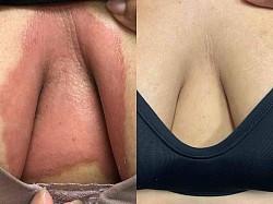 Psoriasis before and after