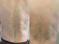 Psoriasis before and after