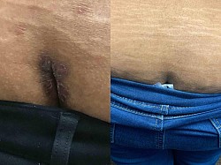 Psoriasis before and after
