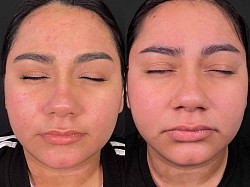 Psoriasis before and after