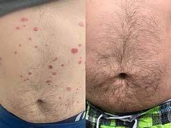 Psoriasis before and after