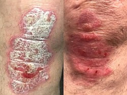 Psoriasis before and after