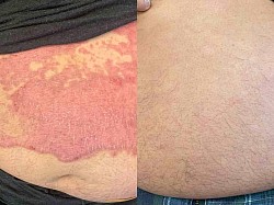 Psoriasis before and after
