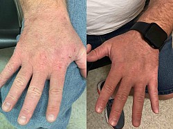 Psoriasis before and after