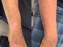 Psoriasis before and after