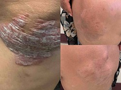 Psoriasis before and after